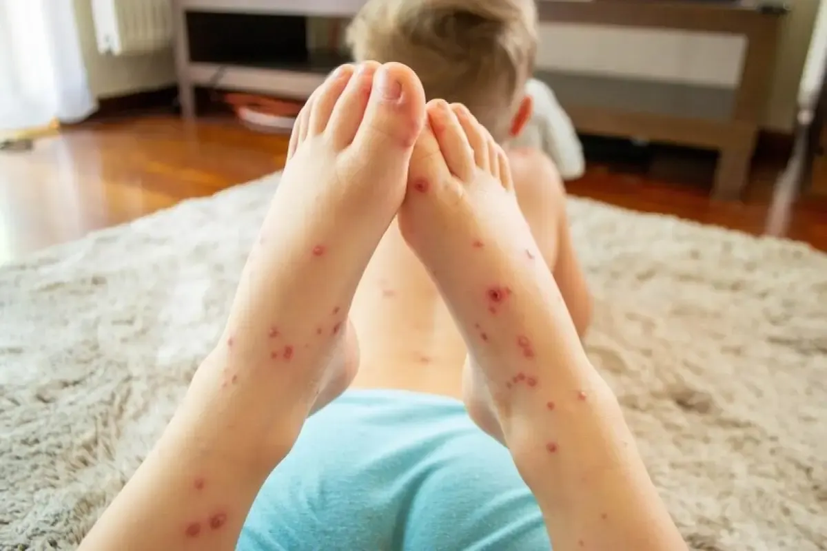 Ilustrasi anak terinfeksi campak atau rubella