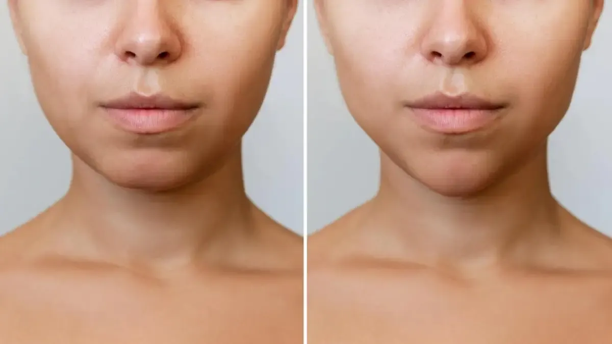 Lagi Tren, Filler Dagu Makin Disukai Setelah Filler Hidung dan Bibir (FOTO: Freepik.com/mari_draiser)