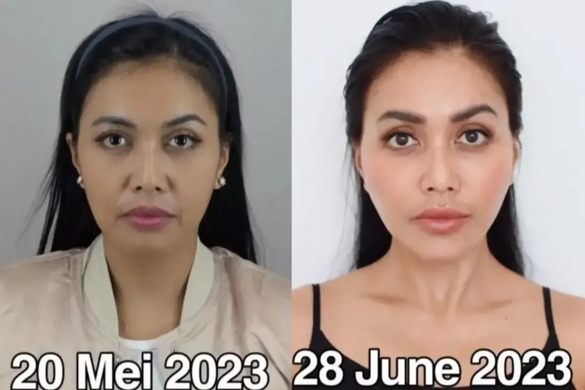 Denada operasi plastik (Instagram.com/denadaindonesia/)