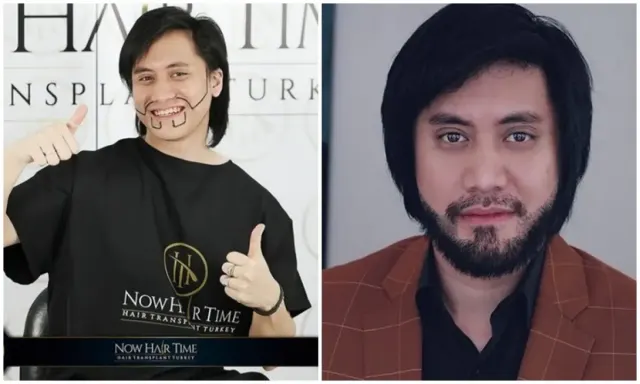 6 Artis Pria Menjalani Transplantasi Rambut, Tampil Makin Ganteng