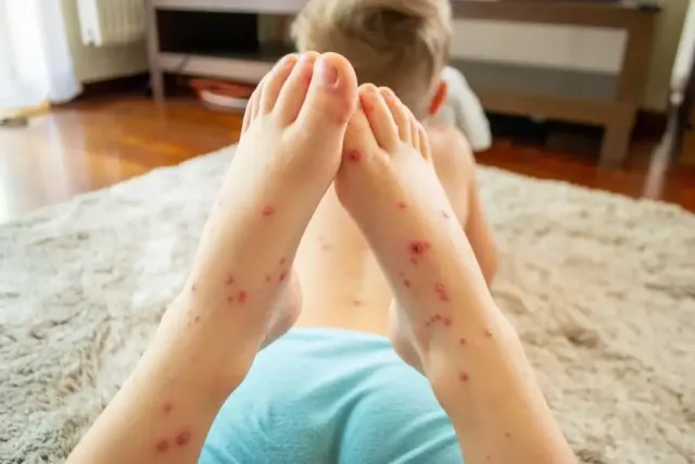 4 Obat Apotek Aman dan Terpecaya yang Ampuh Atasi Campak