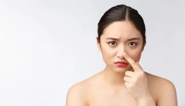 3 Tips Mudah Atasi Komedo dengan 3 Bahan Rumahan Ini