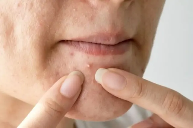 Pahami Penyebab Jerawat di Dagu, Begini Cara Mengobatinya