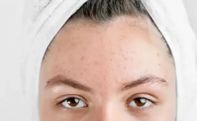 6 Rekomendasi Skincare untuk Wajah Berjerawat, Bikin Jadi Mulus