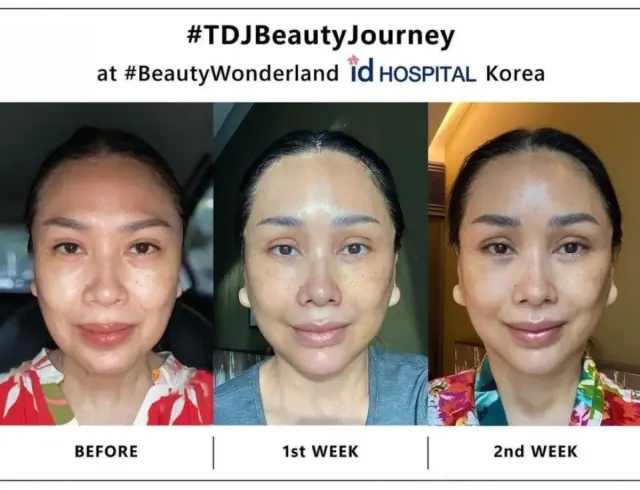 Apa Itu Prosedur Facelift yang Dijalani Titi DJ?