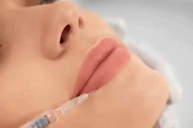 Kisaran Biaya Filler Bibir, Cantik Harus Pakai Modal Cin!