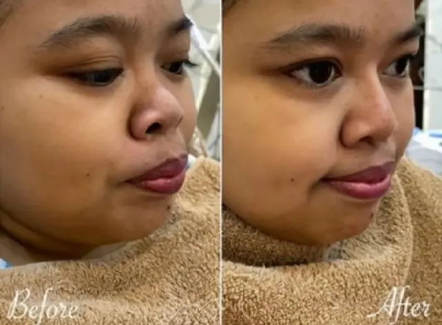 Intip Biaya Filler Hidung! Kekeyi Sudah Pakai, Masa Kamu Nggak?