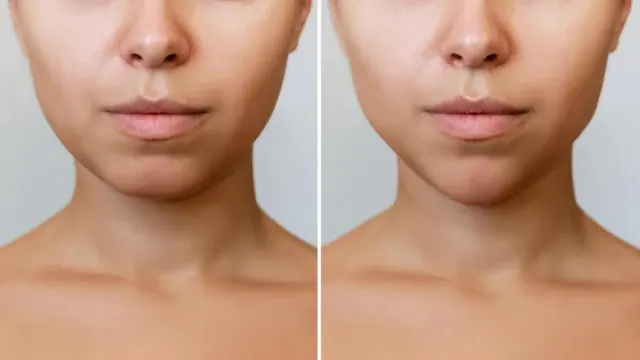 Lagi Tren, Filler Dagu Makin Disukai Setelah Filler Hidung dan Bibir