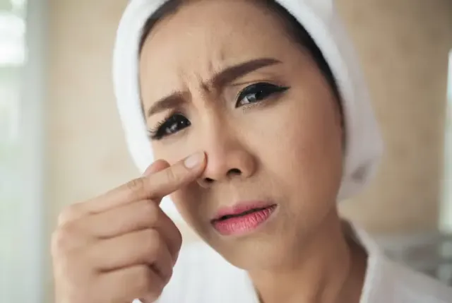 Mengenal Komedo, Penyebab, dan Cara Mengatasinya