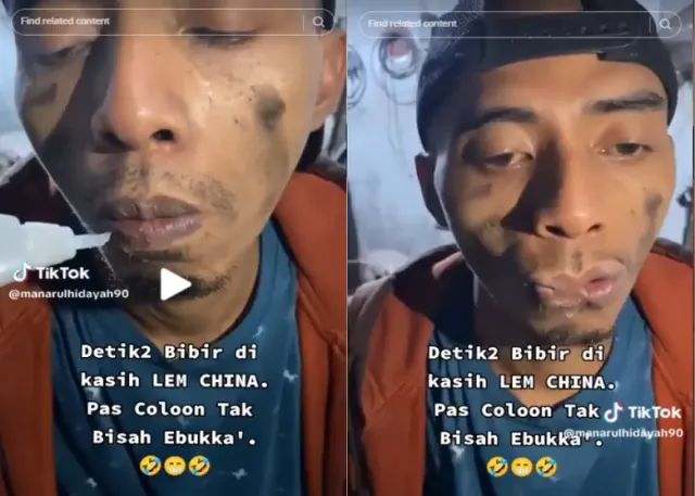 Nekat Oleskan Lem China, Bibir Pria Asal Madura Ini Menempel dan Sulit Dilepas