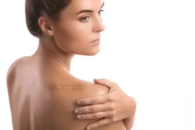 Faktor Penyebab Keloid dan Cara Menghilangkannya