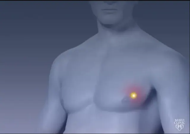 Apa Itu Gyno? Pembesaran Payudara Pria yang Bentuknya Menyerupai Wanita, Kenali Gejala, Penyebab, dan Pengobatannya